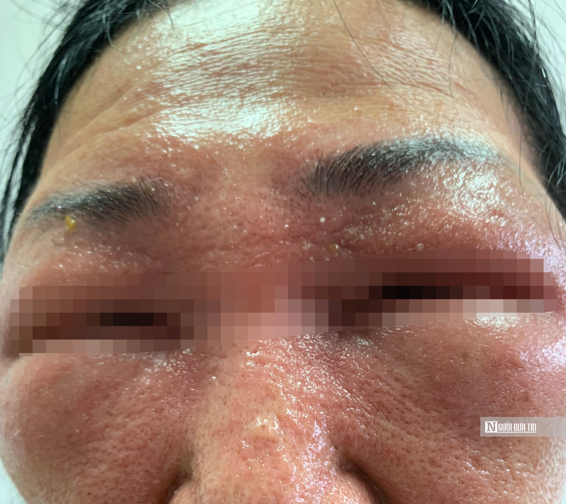 Loại côn trùng nọc độc hơn rắn hổ mang cắn khiến 2 người sưng vù mắt