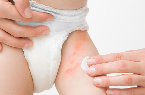 Bước vào đợt lạnh ở miền bắc, tình trạng hăm tã ở trẻ sơ sinh và trẻ nhỏ tăng đột biến, mẹ đã biết cách chăm sóc chưa?